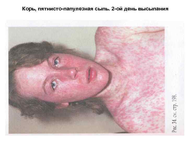 Корь, пятнисто-папулезная сыпь. 2 -ой день высыпания 
