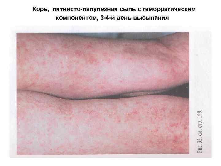 Корь, пятнисто-папулезная сыпь с геморрагическим компонентом, 3 -4 -й день высыпания 