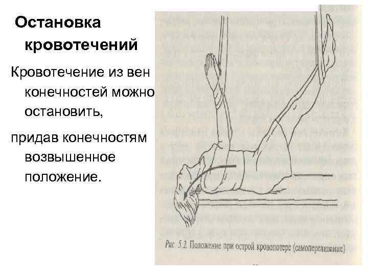 Придать положение. Возвышенное положение конечности. Придать конечности возвышенное положение. Остановка кровотечения возвышенным положением конечности. Возвышенное положение конечности при кровотечении.