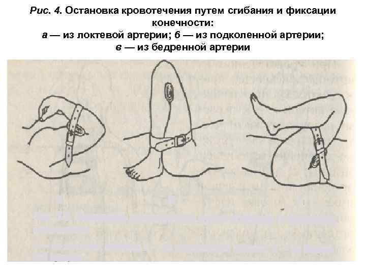 Норколут для остановки кровотечения схема