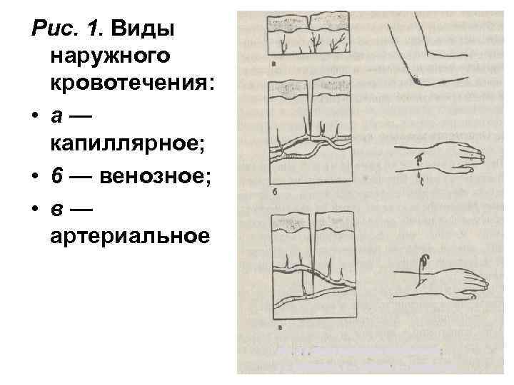 Определить вид кровотечения по рисунку