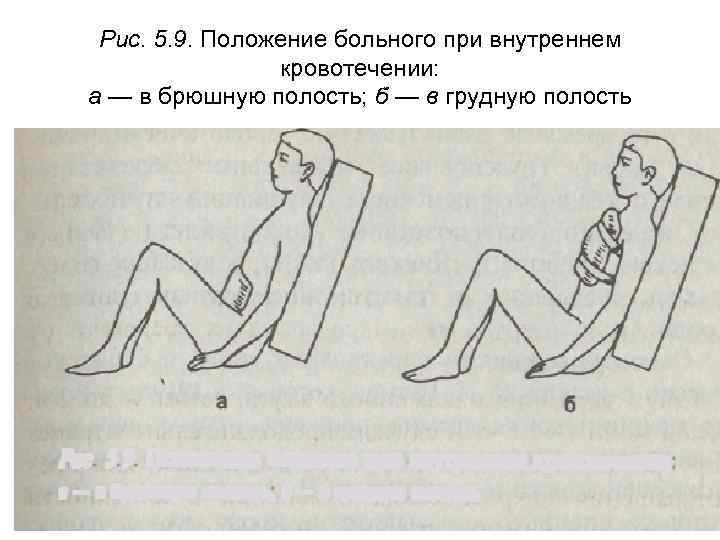 Положение тела. Положение пациента при легочном кровотечении. Положение при кровотечении в брюшную полость. Положение больного при внутреннем кровотечении. Положения пациента при лёгочном кровотичении.