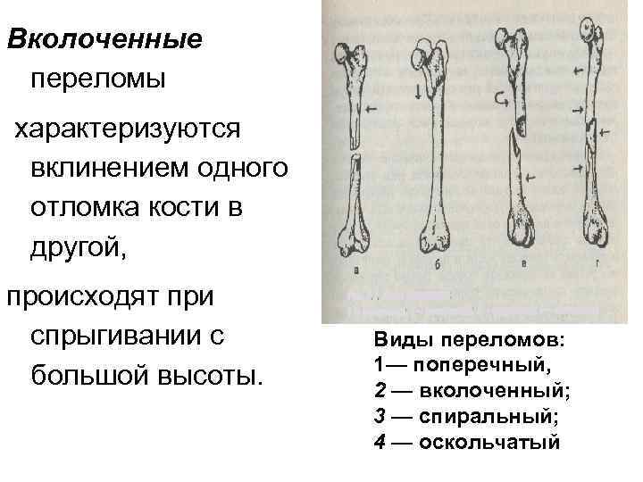 Открытая репозиция костных отломков