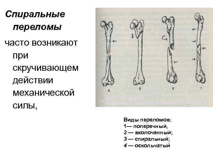 Спиральные переломы часто возникают при скручивающем действии механической силы, Виды переломов: 1— поперечный, 2