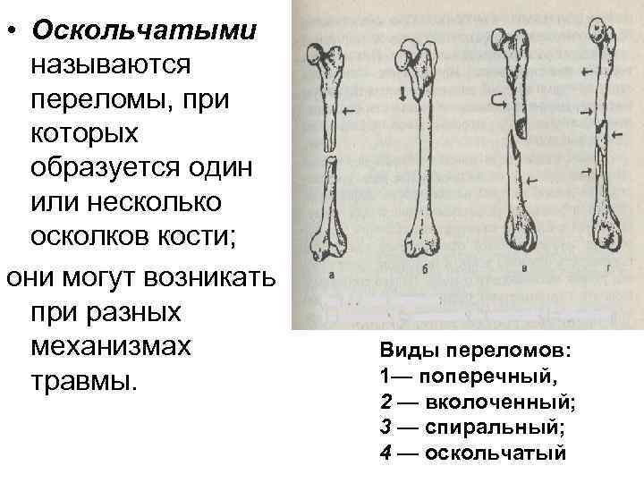 Оскольчатые переломы костей