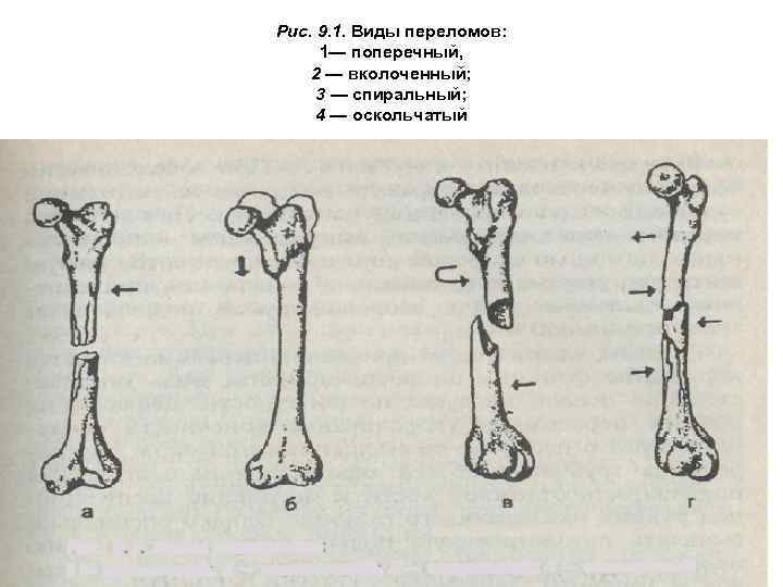 Рис. 9. 1. Виды переломов: 1— поперечный, 2 — вколоченный; 3 — спиральный; 4