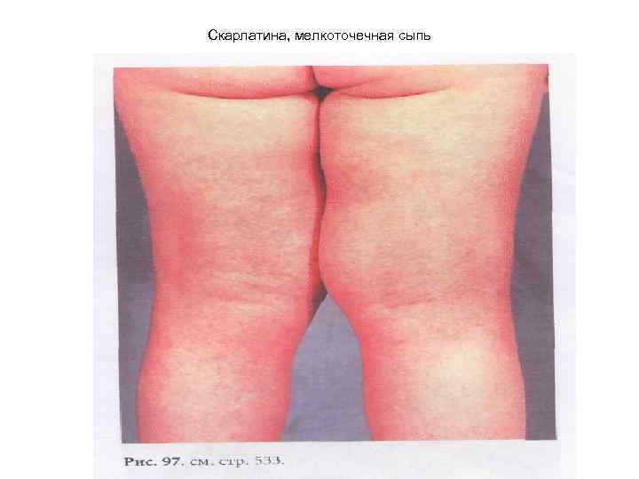 Скарлатина, мелкоточечная сыпь 