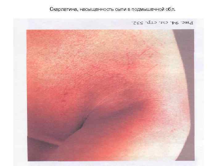 Скарлатина, насыщенность сыпи в подмышечной обл. 