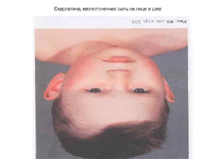 Скарлатина, мелкоточечная сыпь на лице и шее 