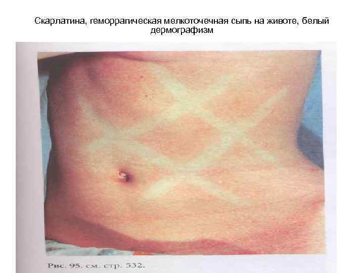 Скарлатина, геморрагическая мелкоточечная сыпь на животе, белый дермографизм 