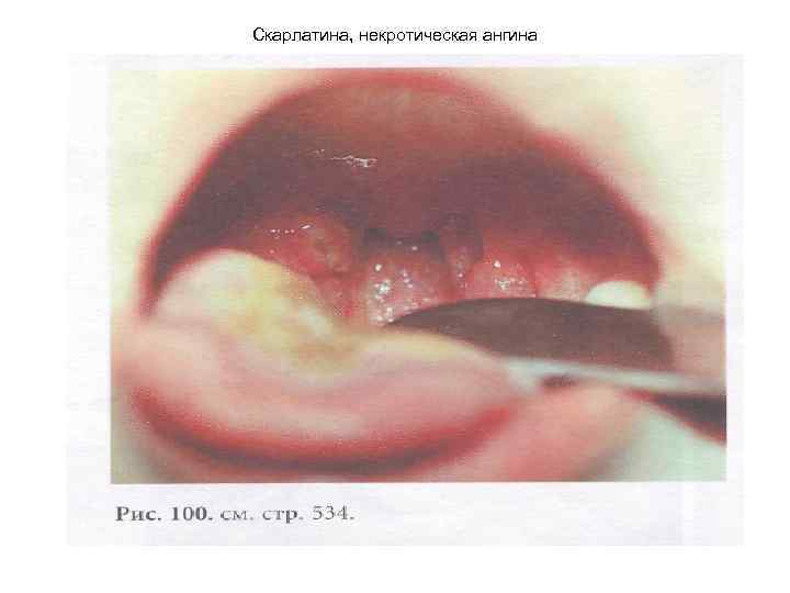 Скарлатина, некротическая ангина 