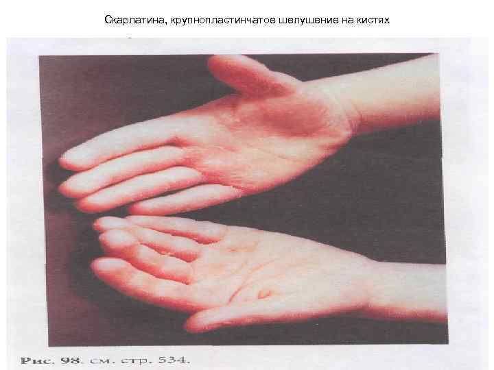 Скарлатина, крупнопластинчатое шелушение на кистях 