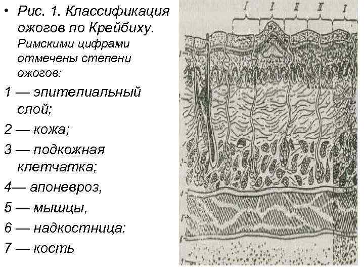  • Рис. 1. Классификация ожогов по Крейбиху. Римскими цифрами отмечены степени ожогов: 1