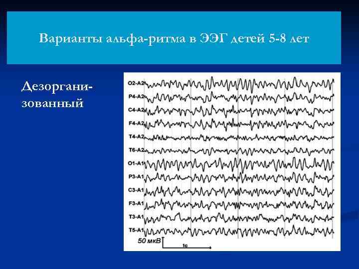 Варианты альфа-ритма в ЭЭГ детей 5 -8 лет Дезорганизованный 