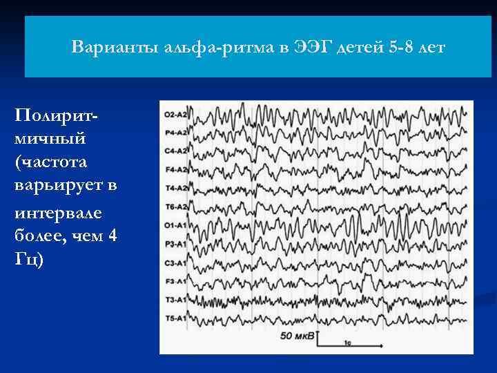 Варианты альфа-ритма в ЭЭГ детей 5 -8 лет Полиритмичный (частота варьирует в интервале более,