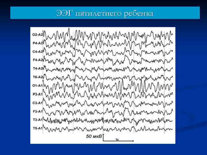 ЭЭГ пятилетнего ребенка 