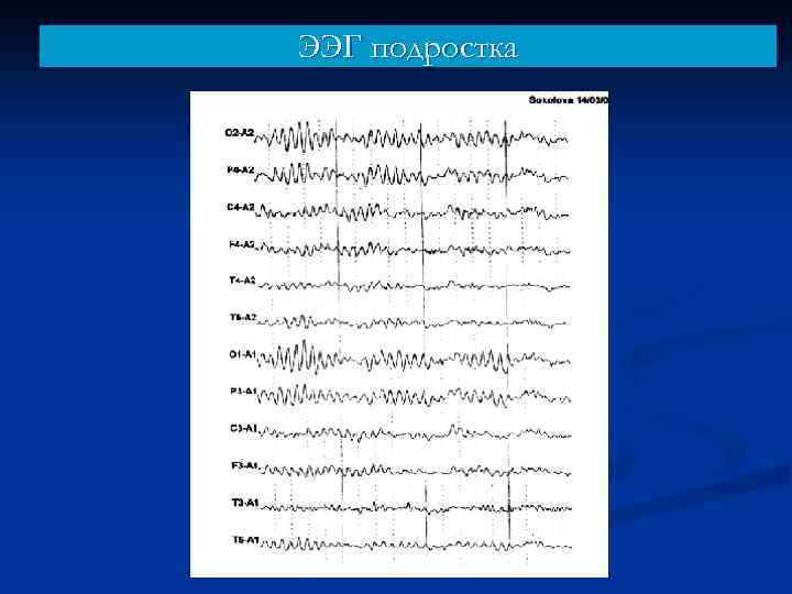 ЭЭГ подростка 