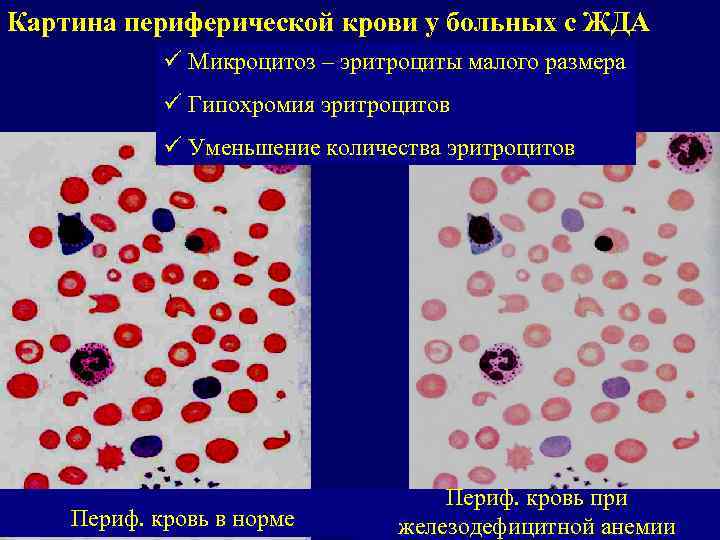Уменьшение объема эритроцитов. Мазок крови при железодефицитной анемии. Гипохромия эритроцитов картина крови. Микроцитарная анемия картина крови.