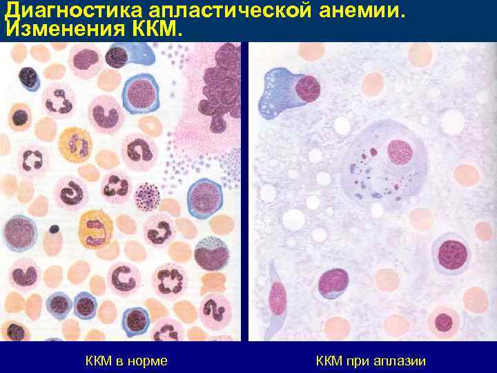 Картина крови при апластической анемии