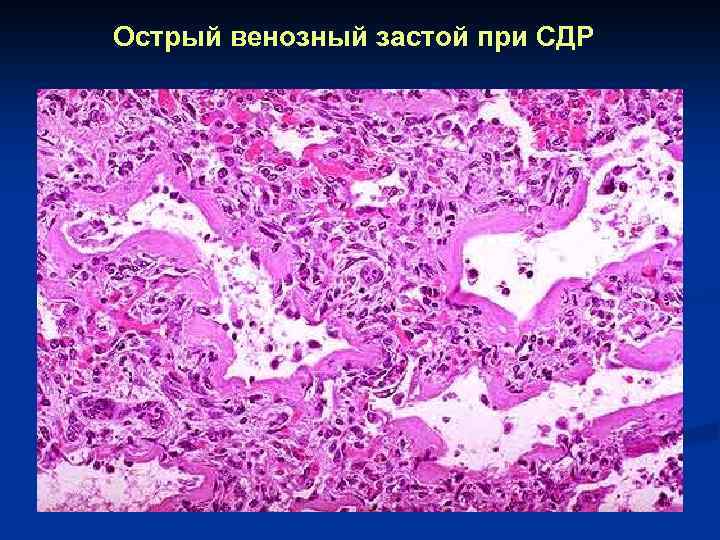 Острый венозный застой при СДР 