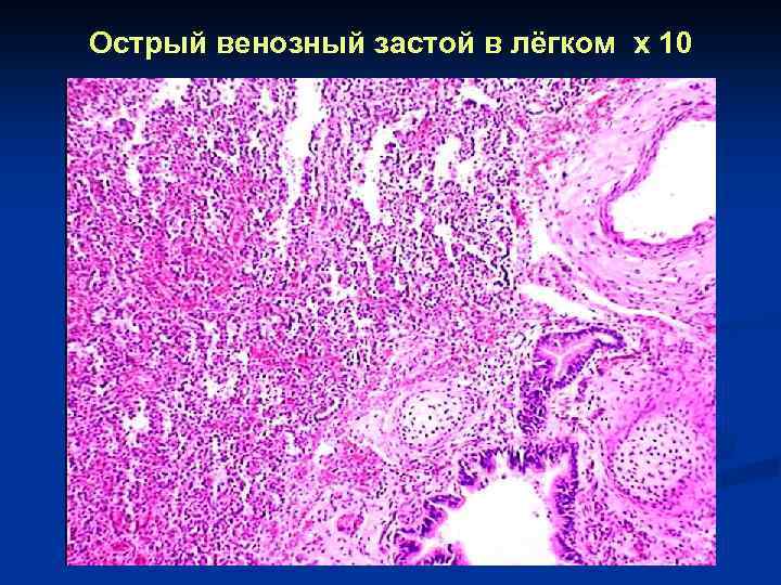 Венозная гиперемия. Венозная гиперемия презентация. Венозный застой острый и хронический. Венозный стаз и венозный застой.