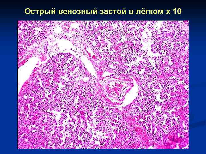 Острый венозный застой в лёгком x 10 