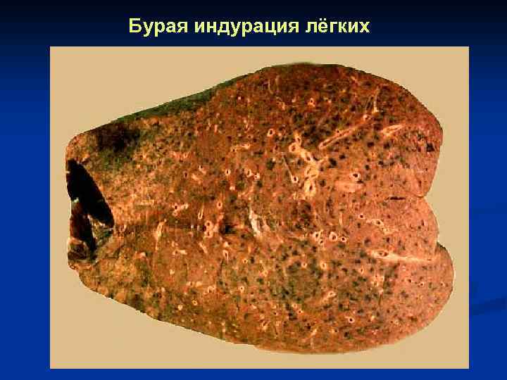 Бурая индурация лёгких 