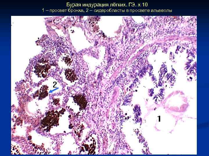 Бурая индурация лёгких. ГЭ. х 10 1 – просвет бронха, 2 – сидеробласты в