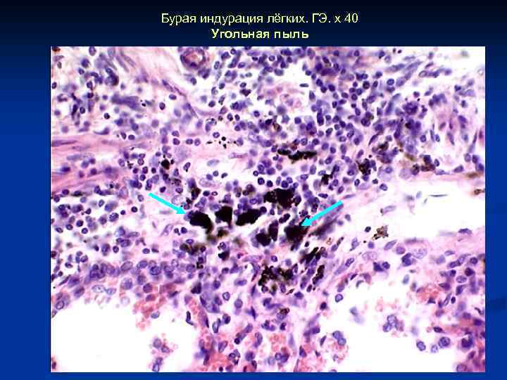 Бурая индурация лёгких. ГЭ. х 40 Угольная пыль 