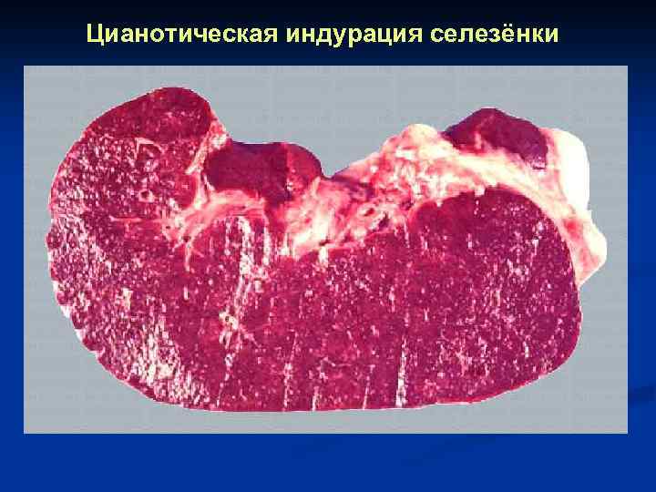 Цианотическая индурация селезёнки 