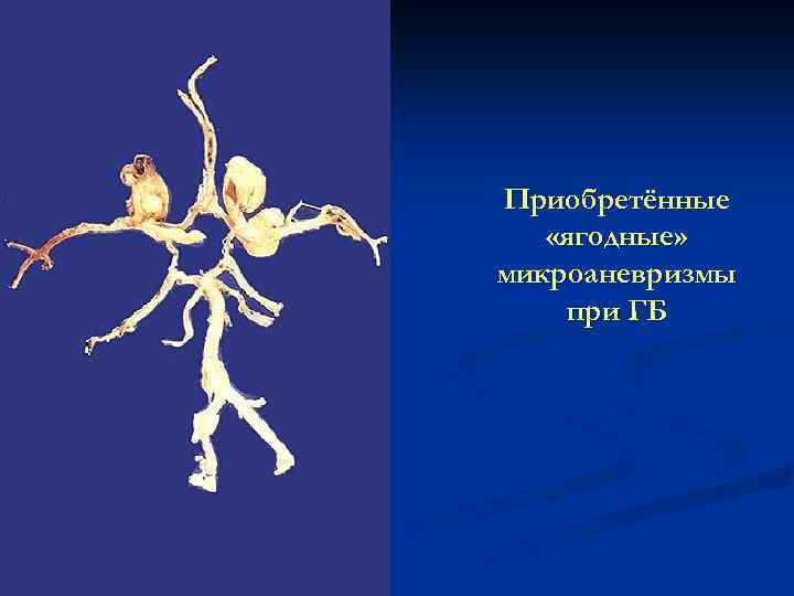 Приобретённые «ягодные» микроаневризмы при ГБ 