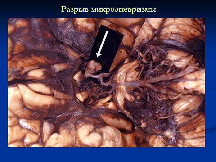 Разрыв микроаневризмы 