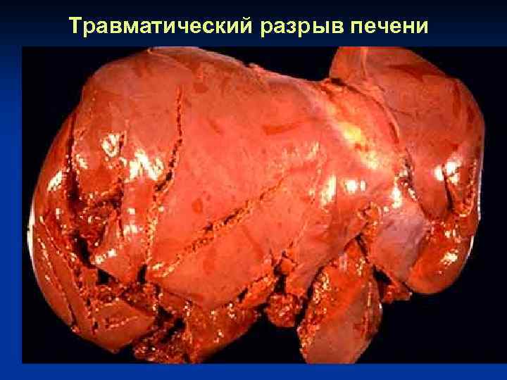 Травматический разрыв печени 