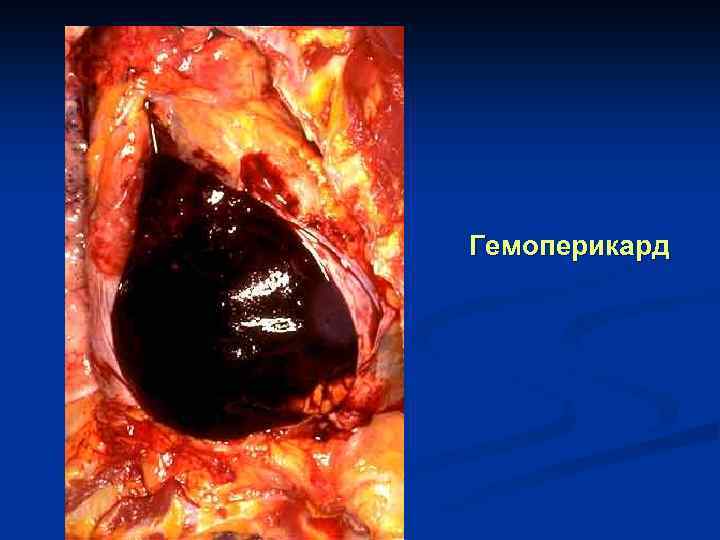 Гемоперикард 