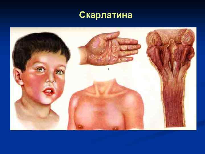 Скарлатина 
