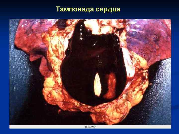 Тампонада сердца 
