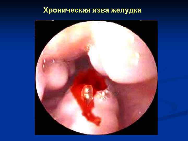 Хроническая язва желудка 