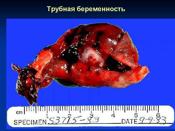 Трубная беременность 