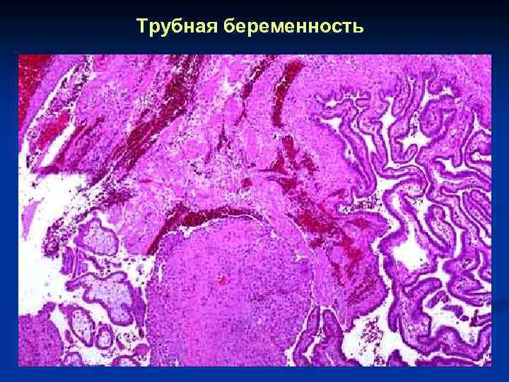 Трубная беременность 