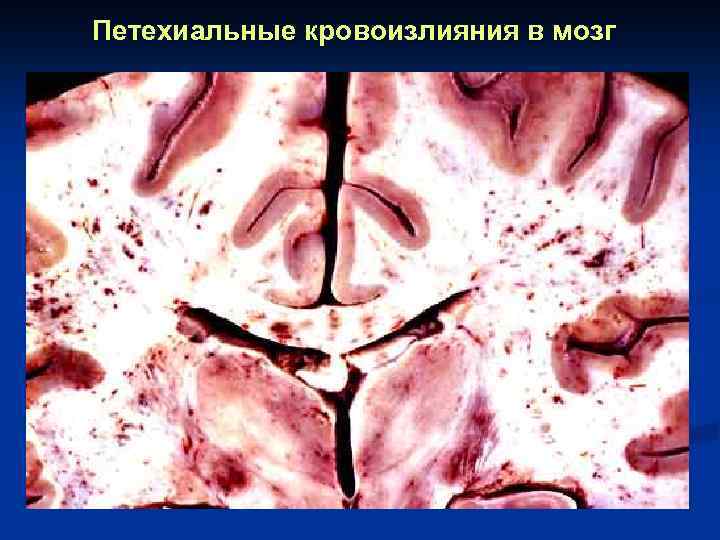 Петехиальные кровоизлияния в мозг 