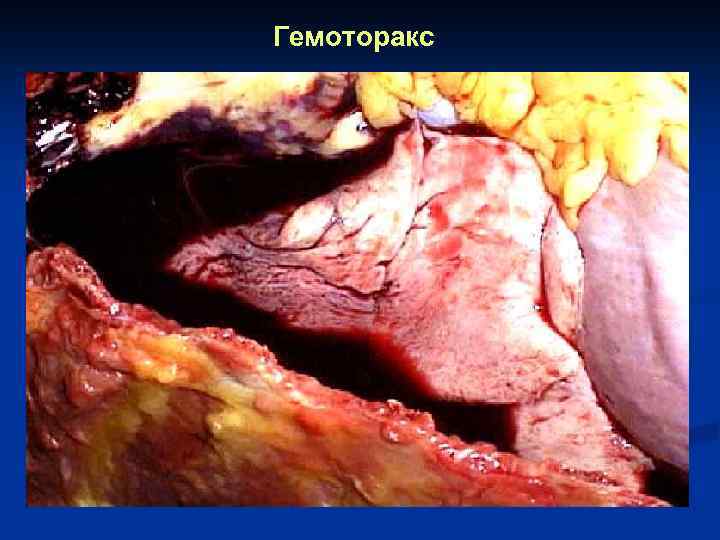 Гемоторакс 