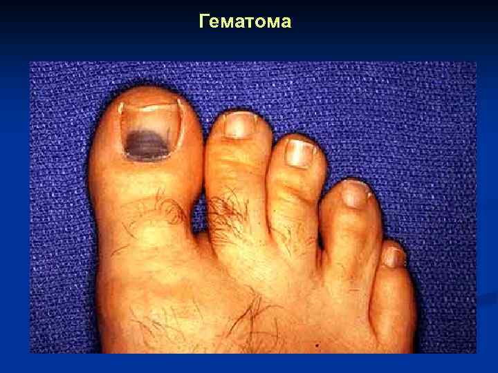 Гематома 