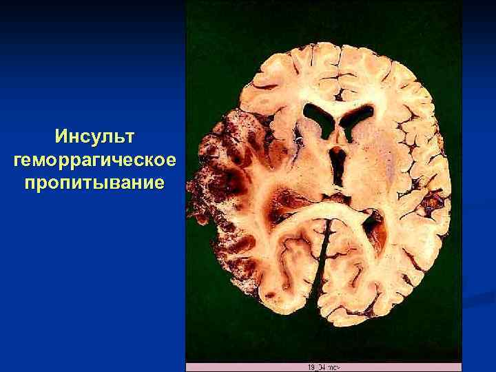 Инсульт геморрагическое пропитывание 