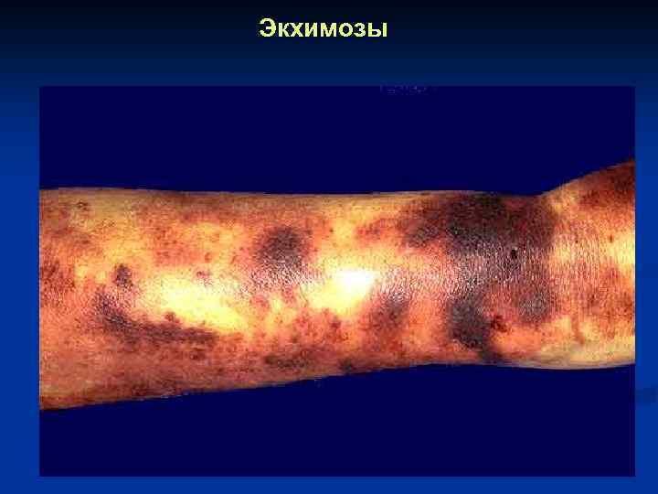 Экхимозы 