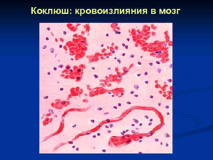 Коклюш: кровоизлияния в мозг 