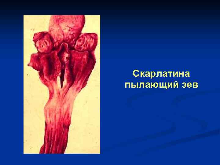 Скарлатина пылающий зев 