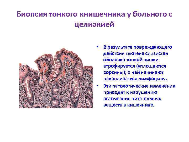 Биопсия тонкого книшечника у больного с целиакией • В результате повреждающего действия глютена слизистая