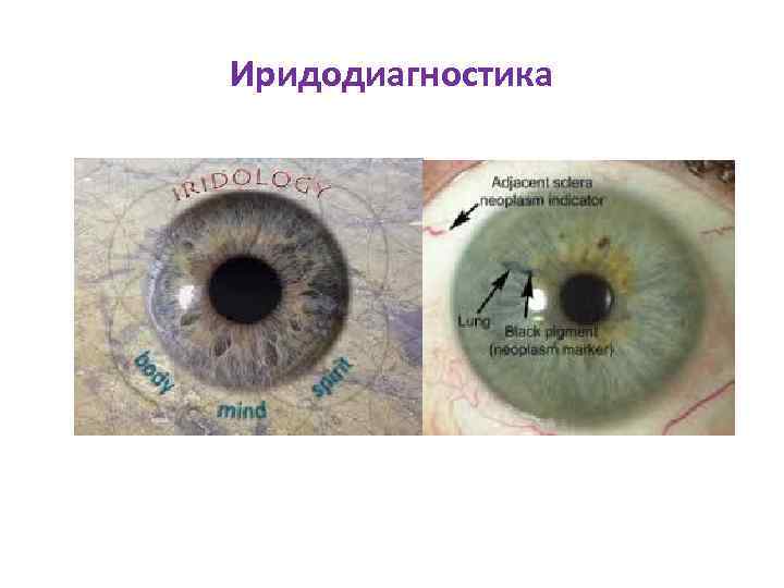 Иридодиагностика 