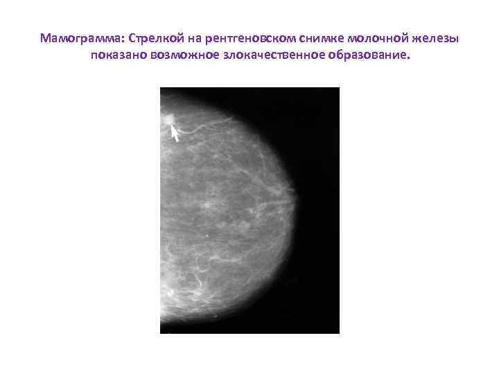 Мамограмма: Стрелкой на рентгеновском снимке молочной железы показано возможное злокачественное образование. 