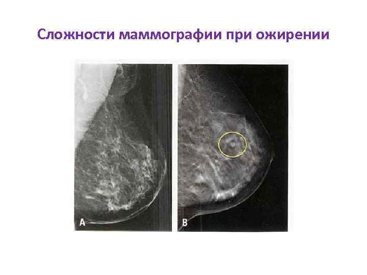 Сложности маммографии при ожирении 